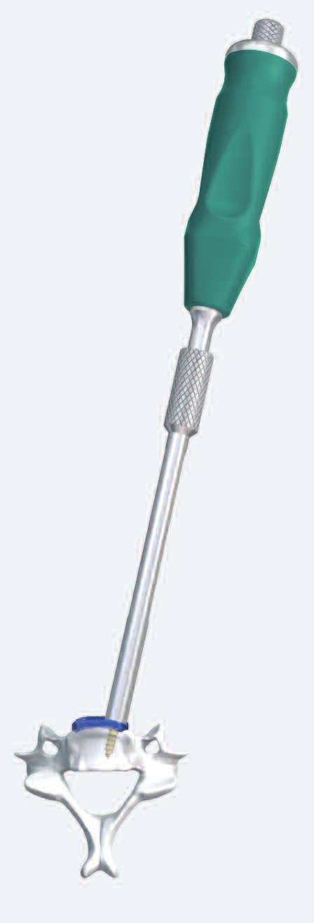 Implantatentfernung 1 Schraubenkopf reinigen Benötigtes Instrument 324.