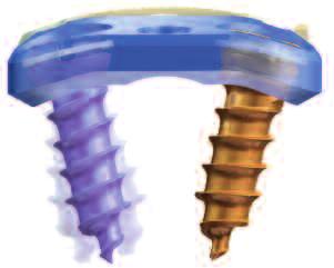 Titanlegierung (TAN) Integrierte Elgiloy-Clips halten die Schrauben in der Platte Schrauben Farbcodierung der Schrauben verweist auf Funktion