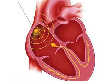 Lektion 1: Die Bedeutung der einzelnen EKG-Zacken Die Bedeutung der einzelnen EKG-Zacken elektrische Impulse entstehen im Sinusknoten