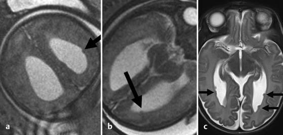 In der MRT zeigt sich eine sanduhrglasförmige Konfiguration des Gehirns mit gelegentlich nur lokalen Anteilen von Pachygyrie oder Polymikrogyrie sowie einer flachen Sylvischen Fissur (Abb. 12) [15].