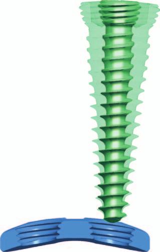 Hoher Widerstand gegen Ausreisskräfte Schraubenkopfgewinde stellt Formschluss mit Platte sicher Schraubenachsen kranial und medial von der Radialachse ausgelenkt Möglichst deckplattenparallele
