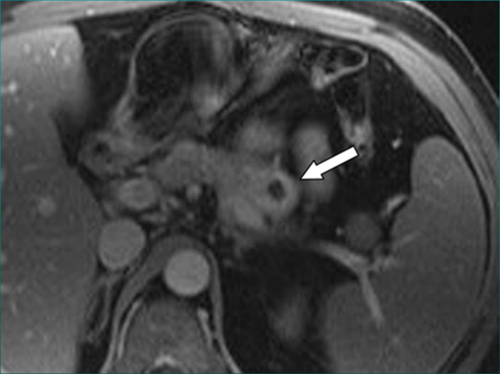 Inselzellkarzinom des Pankreas ausgehend von Langerhansschen Inselzellen hypervaskularisierter Primarius und Metastasen CT + C T1 FS -