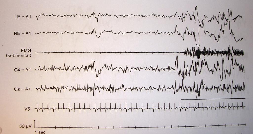 Ergebnisse Abbildung 4: Aufzeichnung eines Arousal (EEG länger als 3 Sekunden mit Frequenzen höher als 16Hz und Alpha-Aktivität; zusätzlich zum EEG Arousal auch eine erhöhte EMG-Amplitude; mehr als
