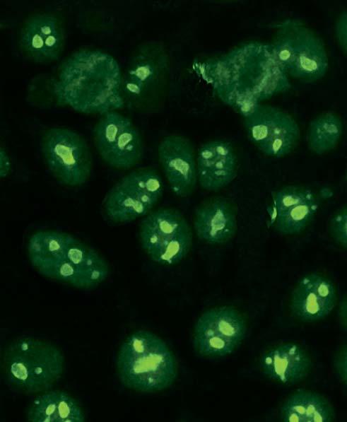Autoantikörper gegen PM-Scl (AC-8) Autoantikörper gegen PM-Scl zeigen in der Immunfluoreszenz bei eine homogene Fluoreszenz der Nukleoli mit gleichzeitig schwächerer, feingranulärer Reaktion des