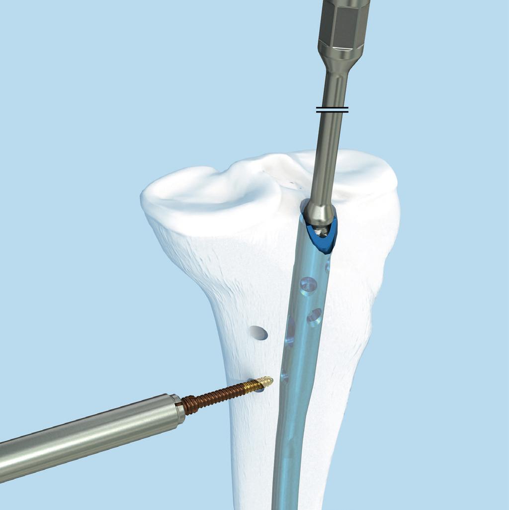 Implantat entfernen 1 Schrauben entfernen Instrumente 03.010.