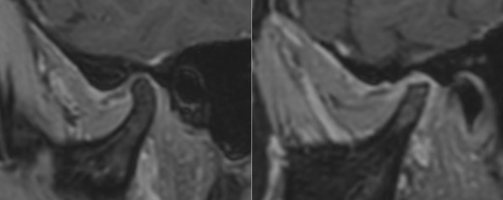 Anteriore Diskusluxation bds. 1. Anteriore Diskusluxation bds.