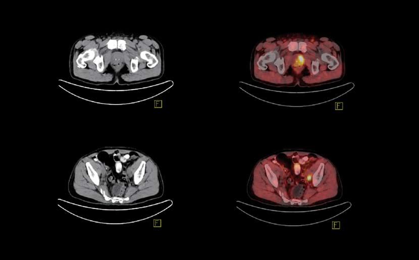 Fotos: TUM Die dreiteilige Bildfolge (links PET, Mitte CT, rechts fusioniertes C-11-Colin) zeigt die Befunde eines 62-jährigen Patienten mit Prostatakarzinom.