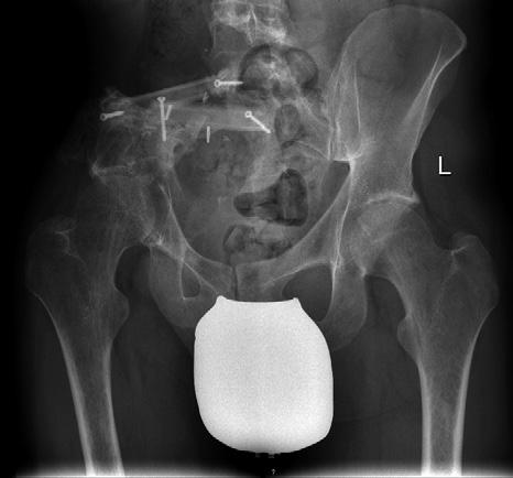 Operative Diagnostik und Therapie von Knochen- und Weichteiltumoren 61 Abbildung 9. 18-jähriger Patient mit Osteosarkom im Bereich der Beckenschaufel.