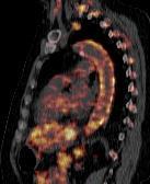 Riesenzellarteriitis mit