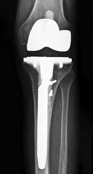 Komplikationsursachen Was sind die Gründe für ein Versagen eines künstlichen Kniegelenks?
