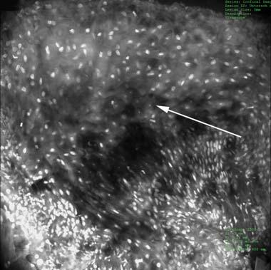 Auffallend sind die großen, vielgestaltigen Zellkerne (Pfeil) im Stratum spinosum
