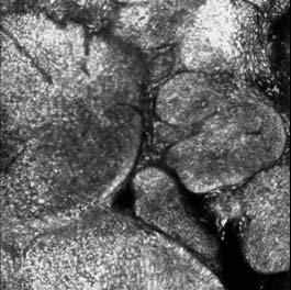Die asymmetrischen Formen der Tumorinseln und die Spaltbildungen (Pfeilspitzen) zwischen den einzelnen Tumorknoten und ihrer Umgebung zeigen sich hier sehr deutlich.