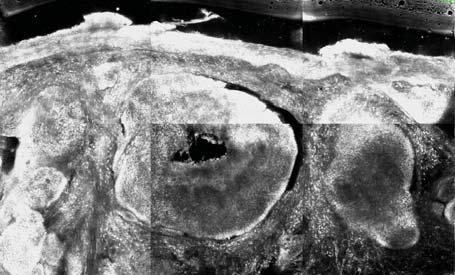 5.6 Aufnahmen semimaligner Tumoren in der KLM Zystisches Basalzellkarzinom Abbildung 94 zeigt das Präparat eines zystisch-nodulären BZK.