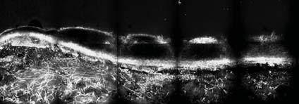 Es können weiße Melanozyten in der DEJ und im Bereich des Koriums (Pfeil) festgestellt werden Abbildung 60: Übersichtsaufnahme eines Nävus