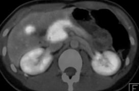 NET des Pankreas Dotanoc-PET-CT Tracer Aufnahme im Corpus/Processus