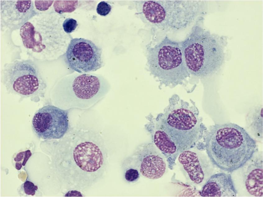 Das Vorliegen einer lymphozytären Alveolitis mit einem CD4/CD8-Quotienten von über 3,5 weist mit einer Spezifität von über 80% und einer Sensitivität von 59% auf eine Sarkoidose hin (35).