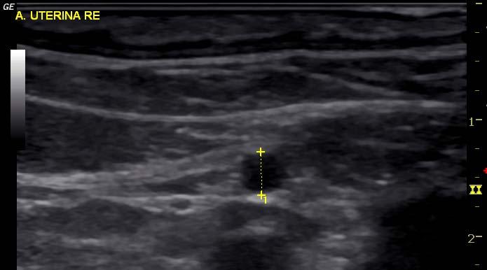 Material und Methoden Abb. 8: Ultrasonographische B-Mode Bild (7,5 Mhz). Bestimmung des Durchmessers der rechten A. uterina zwei Tage post ovulationem.