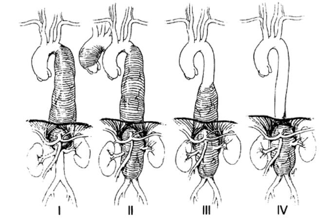 77 Klassifikation des TAAA nach Crawford Typ I: Das Aneurysma beginnt am Abgang der linken A. subclavia und umfasst die gesamte absteigende thorakale wie auch die proximale abdominelle Aorta.