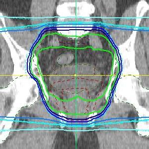 Bestrahlung der Prostata und Becken-LK (definitive RT) Vergleich IMRT versus