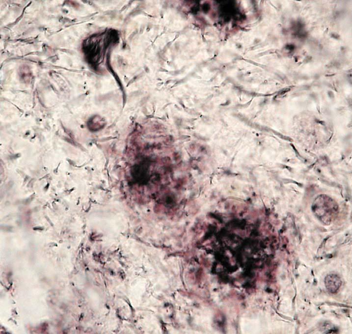 Morbus Alzheimer Neurofibrilläre Tangles