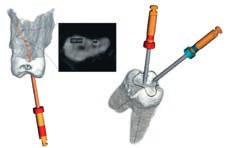 Mit einem kleinen 3D-Volumen von 5 cm x 5,5 cm verfügen die Orthophos-Geräte über ein Field of View, das optimal für endodontische Fragestellungen geeignet ist.