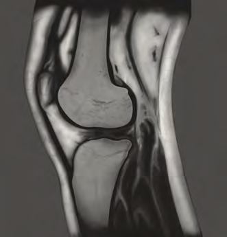Kernspintomographie (MRT) Erkrankungstypische patellofemorale MRT-Parameter wurdem im Stehen mit und ohne Orthese mit durchgestreckten Knien sowie bei kontrollierter Flexion von 15 und 30 untersucht.