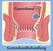 Therapie (Gummiband) Gummiband am effekhvsten (Grad II) Tiefste Rezidivrate Erfolgsrate 80% Schmerzen 2% Blutung 1% Harnverhalt <1% Sklerosierung, Kryotherapie,