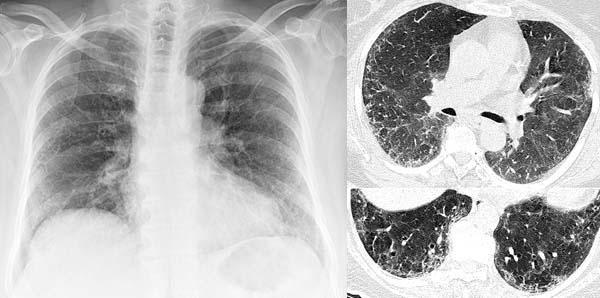 Die Lungenfibrose im Röntgenbild und im CT Wie unterscheidet man eine COPD/Lungenemphysem von einer Lungenfibrose?
