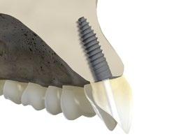 Diese Technik sollte nur von Zahnärzten angewandt werden, die über eine adäquate Erfahrung in der Anwendung von Augmentationsverfahren verfügen. Die Knochenschicht muss mindestens 1 mm dick sein.