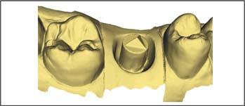 Sirona Dental Systems GmbH 14 Konstruktionsbeispiele 14.1 Abutment - Biogenerik Individuell - MultiLayer 14.1.2 Präparation aufnehmen 1. Nehmen Sie die Präparation auf (siehe Phase AUFNAHME [ 91] ).
