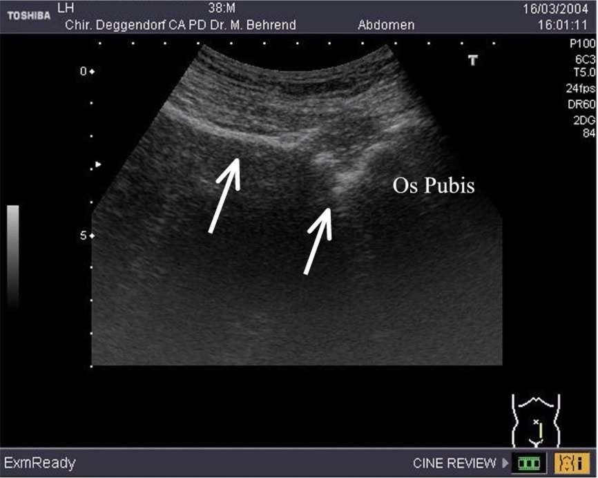 2 cm unter dem Schallkopf nachweisbar sein. Nur bei einem Patienten war die peritoneale Verschieblichkeit deutlich herabgesetzt.