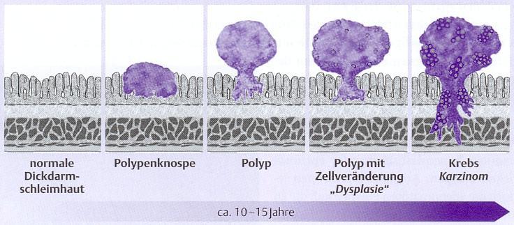 ADENOM-KARZINOM-SEQUENZ Quelle: