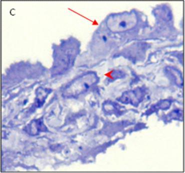 Innerhalb der Zellstruktur Anschnitte von Zellkörpern. Extrazelluläre Räume mit fibrillärem Material angefüllt (rote Pfeilspitzen). C: Bildausschnitt aus B. Lichtmikroskopie A und B x 100, C x 200 5.