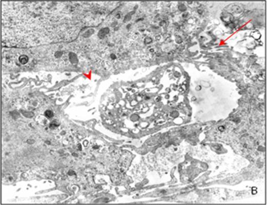 Zwischen Keratinozyten und Endothelzellen zeigte sich stets ein erweiterter mit homogenem Material angefüllter Interzellularraum, in den ausschließlich die Zellfortsätze der Endothelzellen