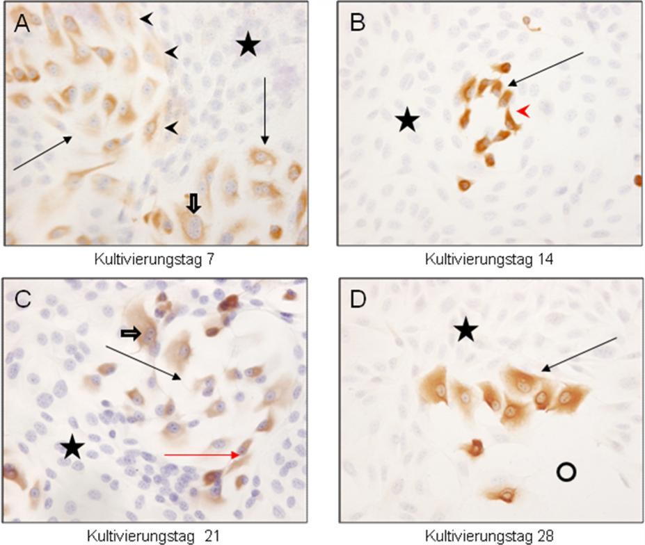 Ergebnisse Abbildung 38: Immunzytochemischer Nachweis von CK19 in Endothelzellen im direkten Kokultur-System 1 (K+E) A-D: Deutliche Markierung von polygonalen Endothelzellen (schwarze Pfeile) mit