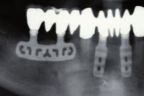 IMPLANTATE STATT PROTHESEN Zahnimplantate sind künstliche Zahnwurzeln, meistens in Form von Schrauben, die in den Kieferknochen eingepflanzt werden (vom lat.