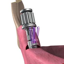 5 Erweiterungsbohrer, Crestalfräse und Gewindeschneider: Die Verwendung der jeweiligen SIC Erweiterungsbohrer und Crestalfräsen ist abhängig vom geplanten Implantatdurchmesser (siehe Chirurgischer