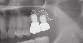 8 Das Röntgenbild 6 Monate postoperativ zeigt die zweite krestale