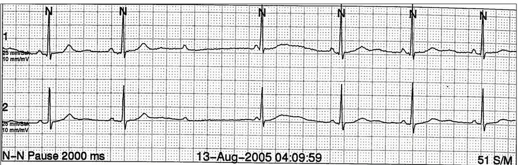 CME Abb. 10 Long-QT-Syndrom Typ 2 ( 25 mm / s): Bradykardie um 47 / min. In den Ableitungen II und V3 V5 finden sich doppelgipflige T-Wellen, die typisch für das Long-QT-Syndrom Typ II sind.