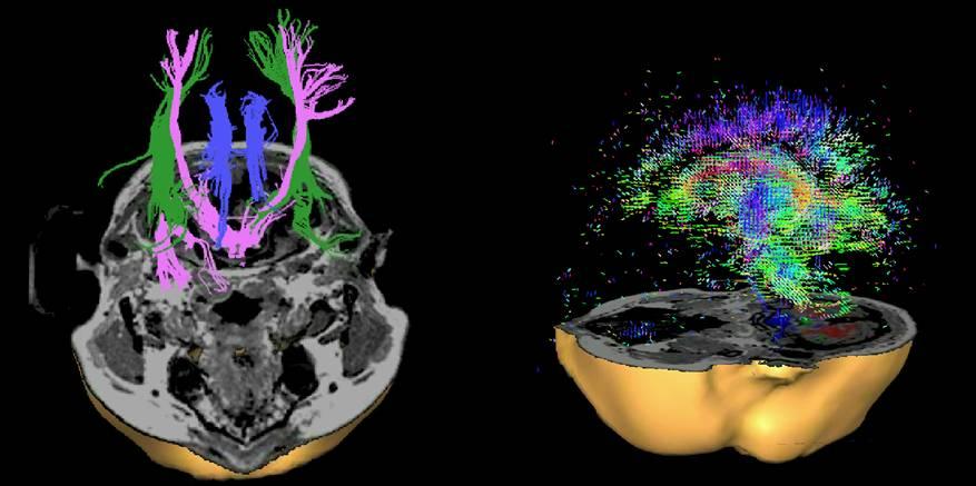 Diffusions-Tensor-Imaging (DTI) fibersdaniel.exe tensorsdaniel.