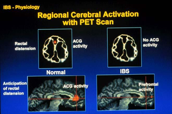 Regional Cerebral Activation with PET Scan