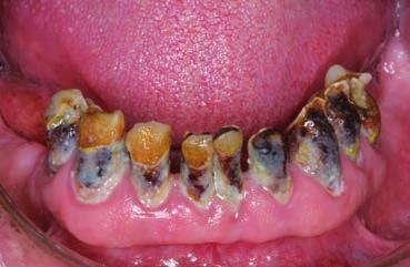 Eingeschränkte Mundhygienefähigkeit bei Arthrose Folgen eingeschränkter Mundhygiene Name Kontaktdaten Zahnärztin/Zahnarzt Mund/Zähne/Prothesen reinigen.