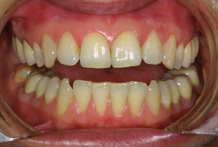 Einführung Gute Mundhygiene trägt zu Wohlbefinden und Lebensqualität bei. Erkrankungen der Zähne (Karies) und des Zahnhalteapparates (Parodontitis) sind vermeidbar.