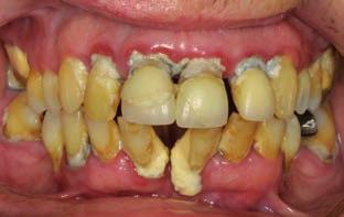 Zahnbeläge und Zahnstein reizen das Zahnfleisch und verursachen Zahnfleischentzündungen Gingivitis.