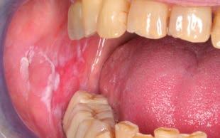Mundschleimhaut verändern und begünstigt auf diese Weise Mundkrebs.