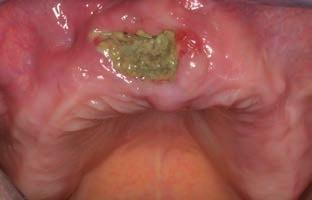 Trockener Mund, eingerissene Mundwinkel Prothesendruckstelle und Wundheilungsstörung unter