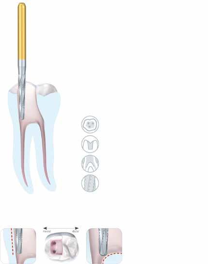 Endodontie Erweiterung Endodontics Reaming EndoGuard Stellt die Weichen auf Endo-Erfolg 12 EndoGuard The course is set for Endo success The creation of a perfect access cavity is the foundation of