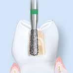 Endodontie Trepanation Endodontics Trepanation Trepanation 4 Trepanation Trepanation is always the first step of the sequence of an endodontic treatment.