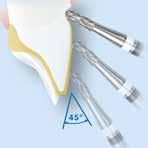 Endodontie Trepanation Endodontics Trepanation H 4 MC / 5 5 Größe Size Ø ¹ ₁₀ mm 010 012 L mm 2,0 2,0 FG Friction Grip (FG) H4MC.314.