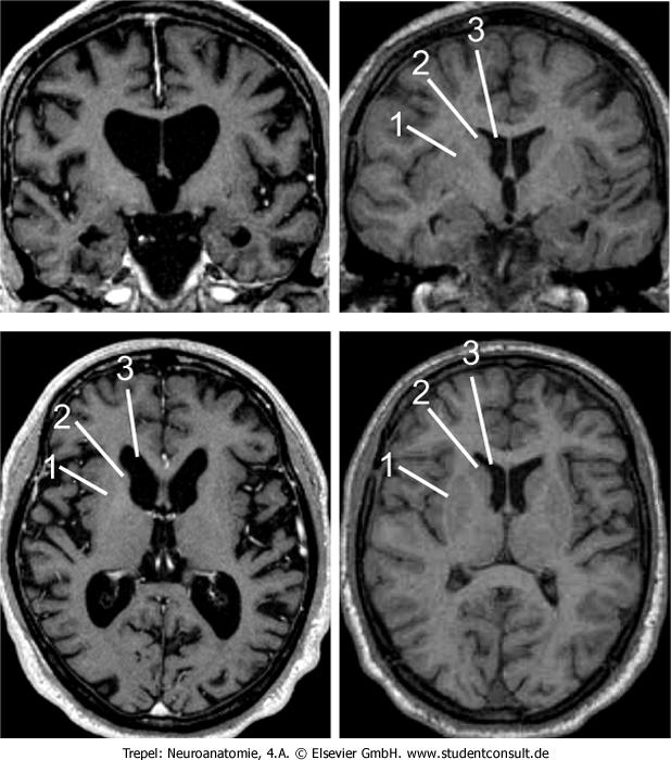 6 Jahren Diagnose, rechtes MRI: gesunder Proband.